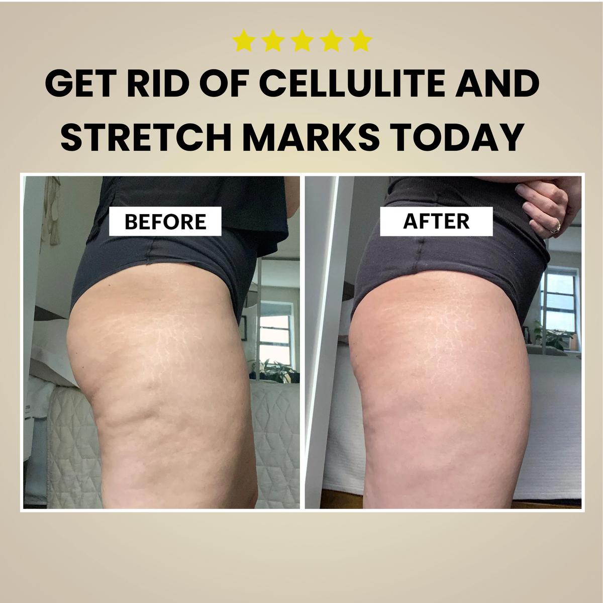 Cellulite Remover